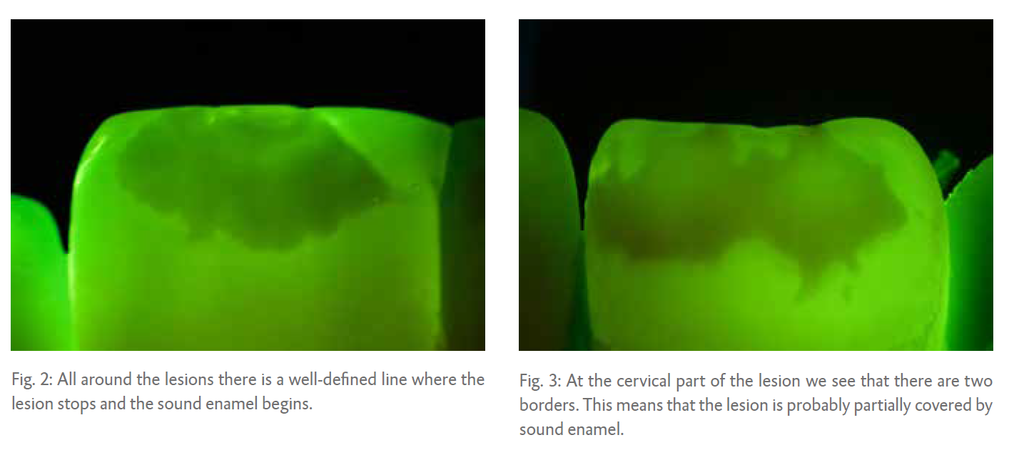 Fig. 2: All around the lesions there is a well-defined line where the lesion stops and the sound enamel begins. Fig. 3: At the cervical part of the lesion we see that there are two borders. This means that the lesion is probably partially covered by sound enamel.